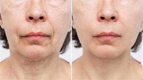Treatment for sagging facial skin